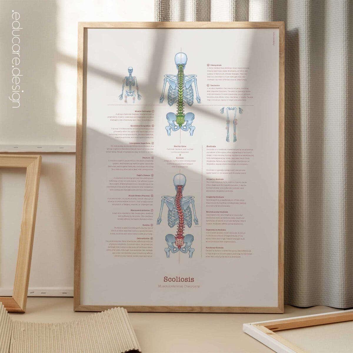 Scoliose et Troubles Musculo-Squelettiques