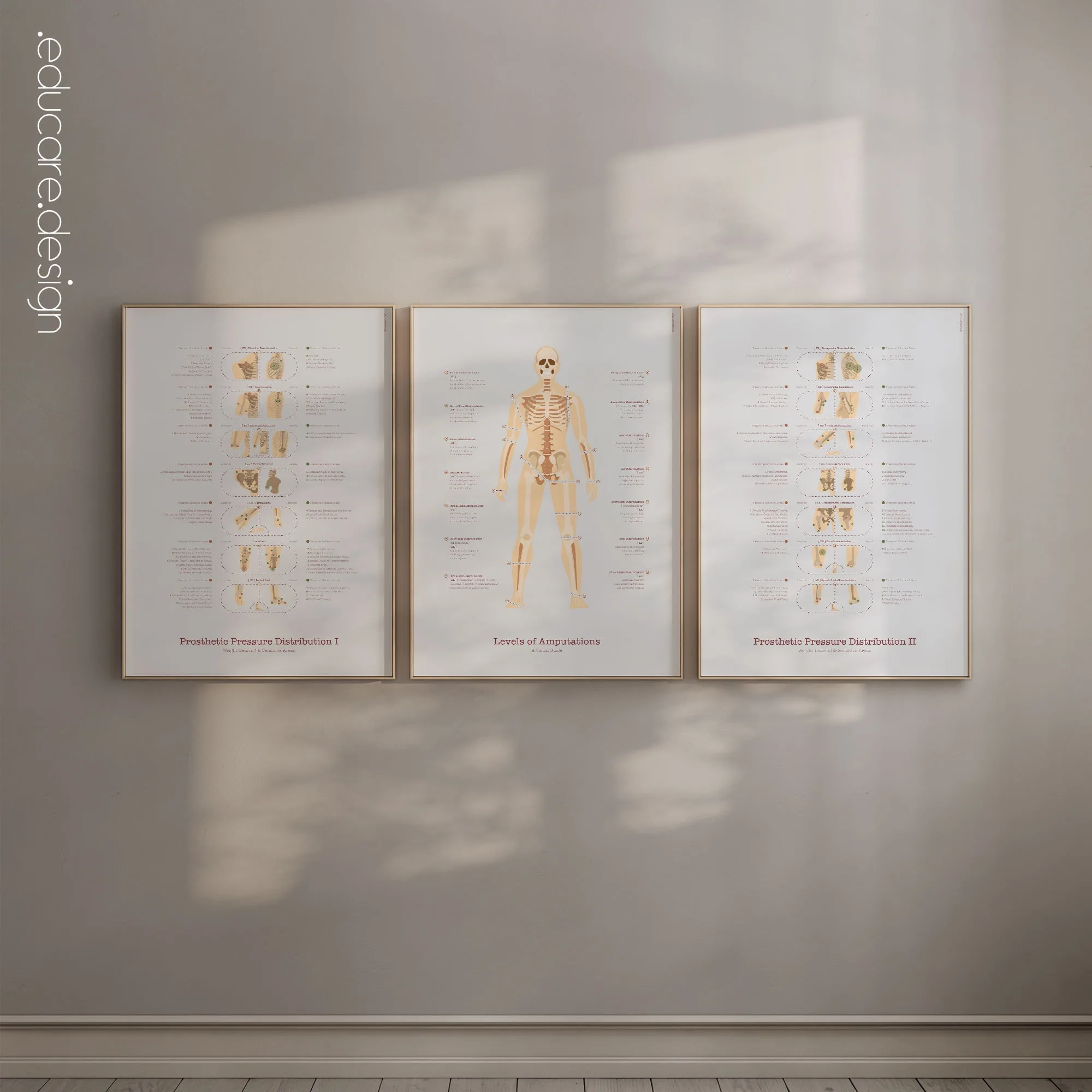 Amputations and Prosthetic Pressure Distribution anatomy chart for clinics