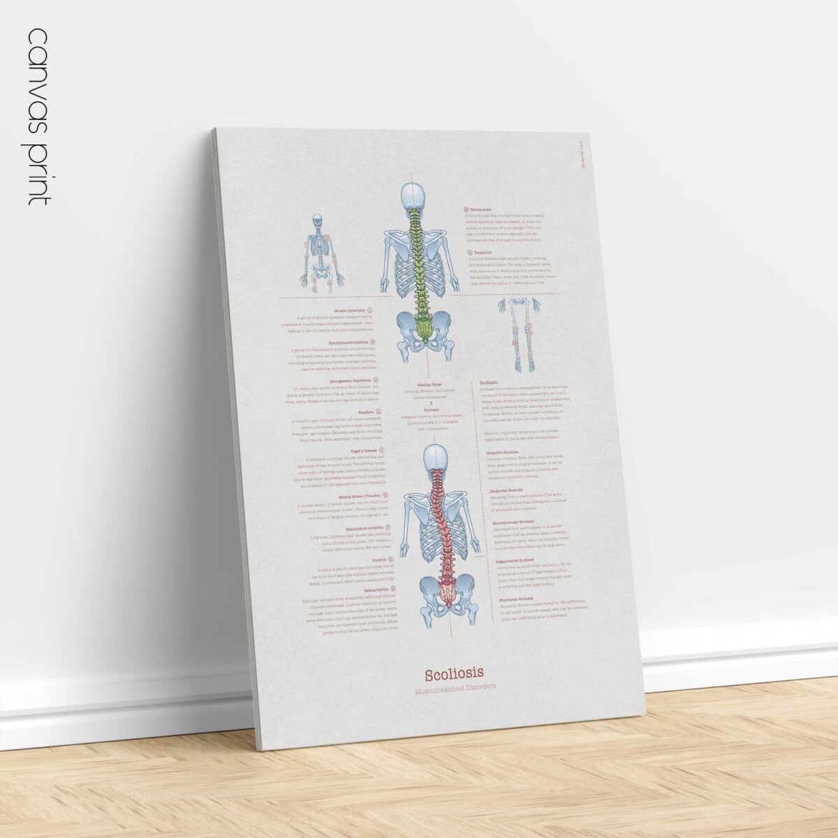 Scoliose et Troubles Musculo-Squelettiques