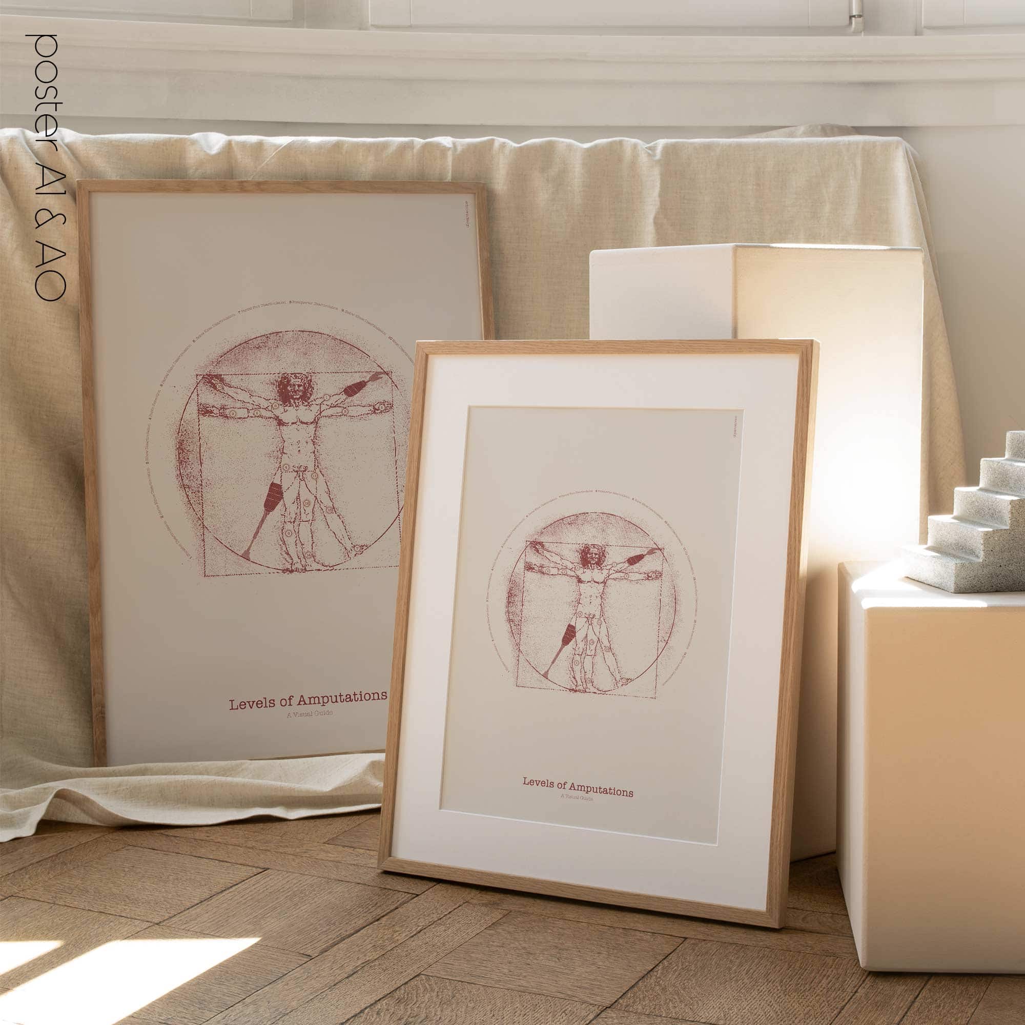 Vetruvian Amputee. Levels of amputations.