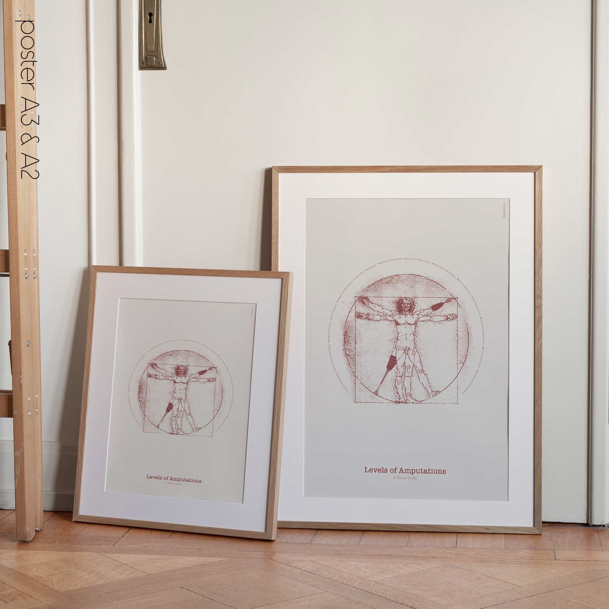 Vetruvian Amputee. Levels of amputations.