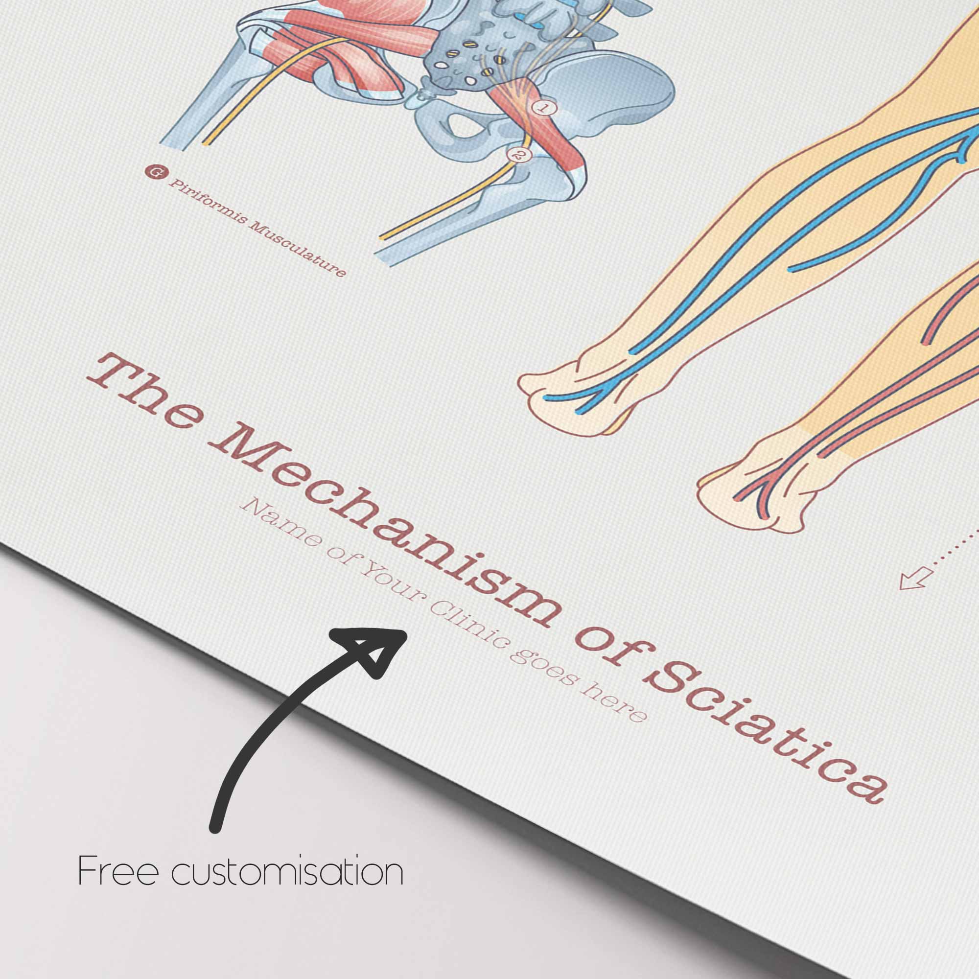 Sciatica with Stenosis, Hernia & Piriformis Syndrome