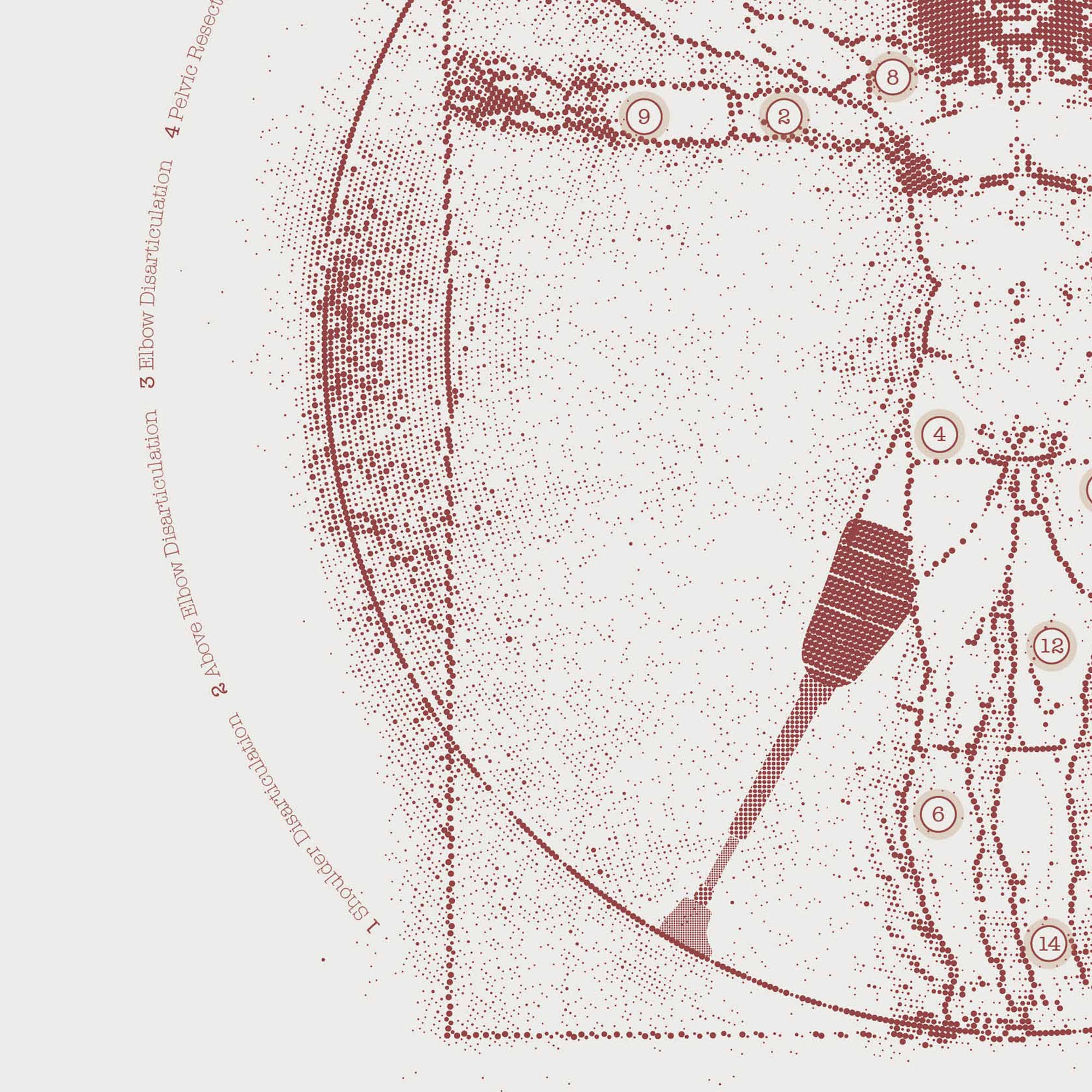 Vetruvian Amputee. Levels of amputations.