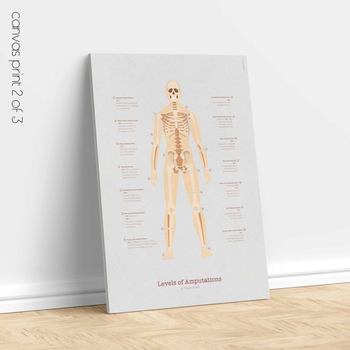Amputations & Prosthetic Pressure Distribution