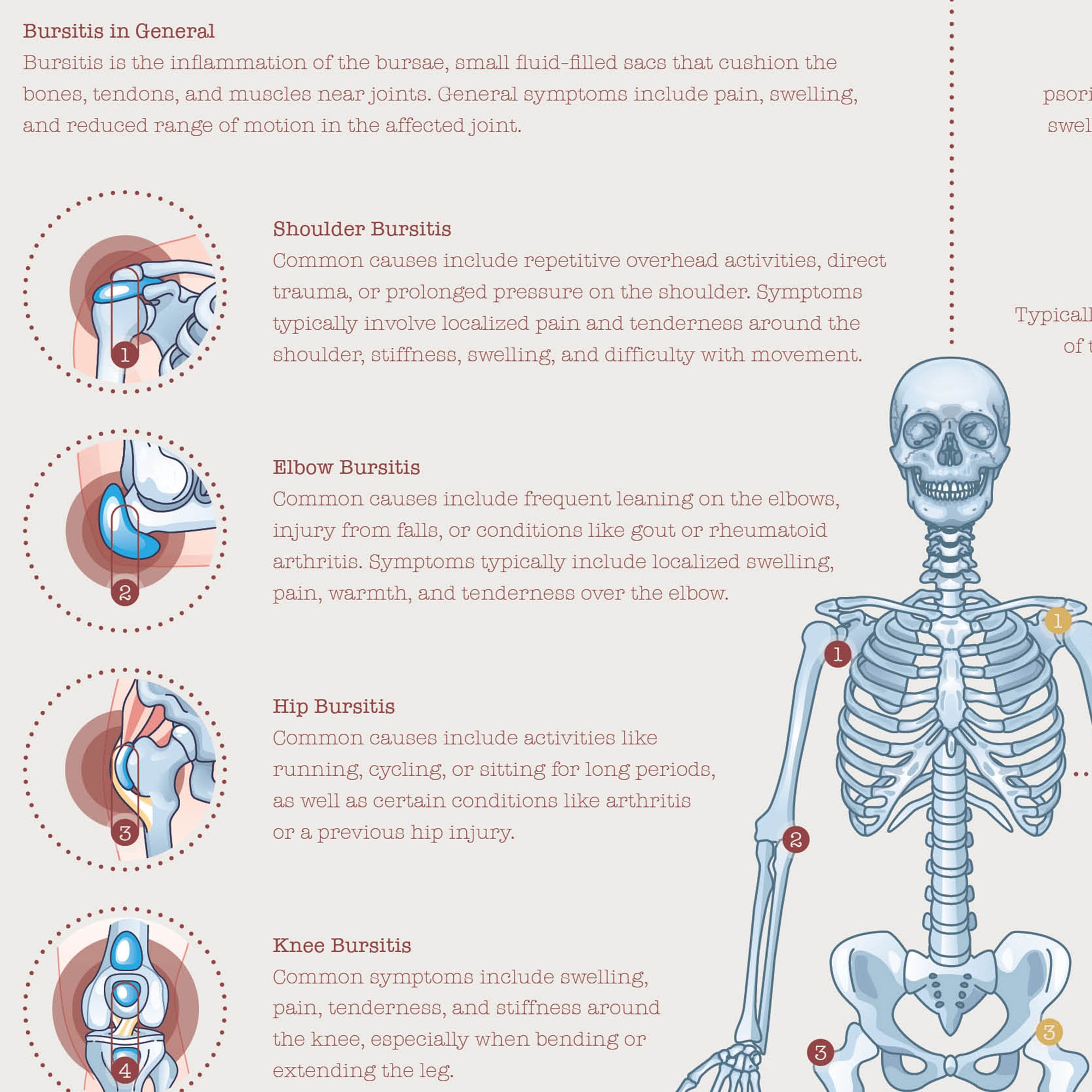 Bursitis Arthritis & Tendonitis