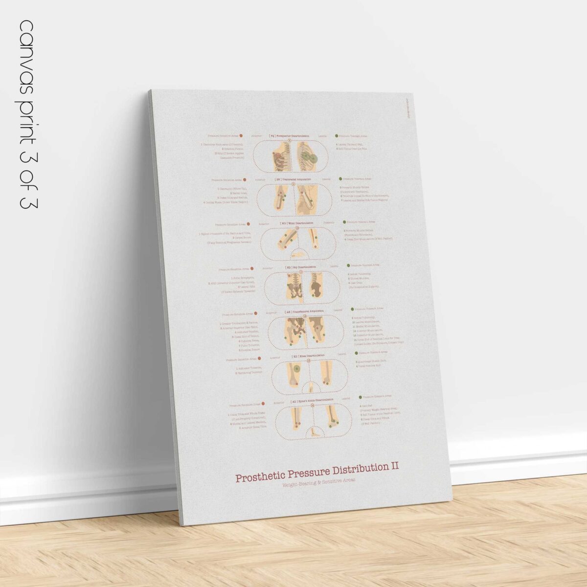 Amputations & Prosthetic Pressure Distribution