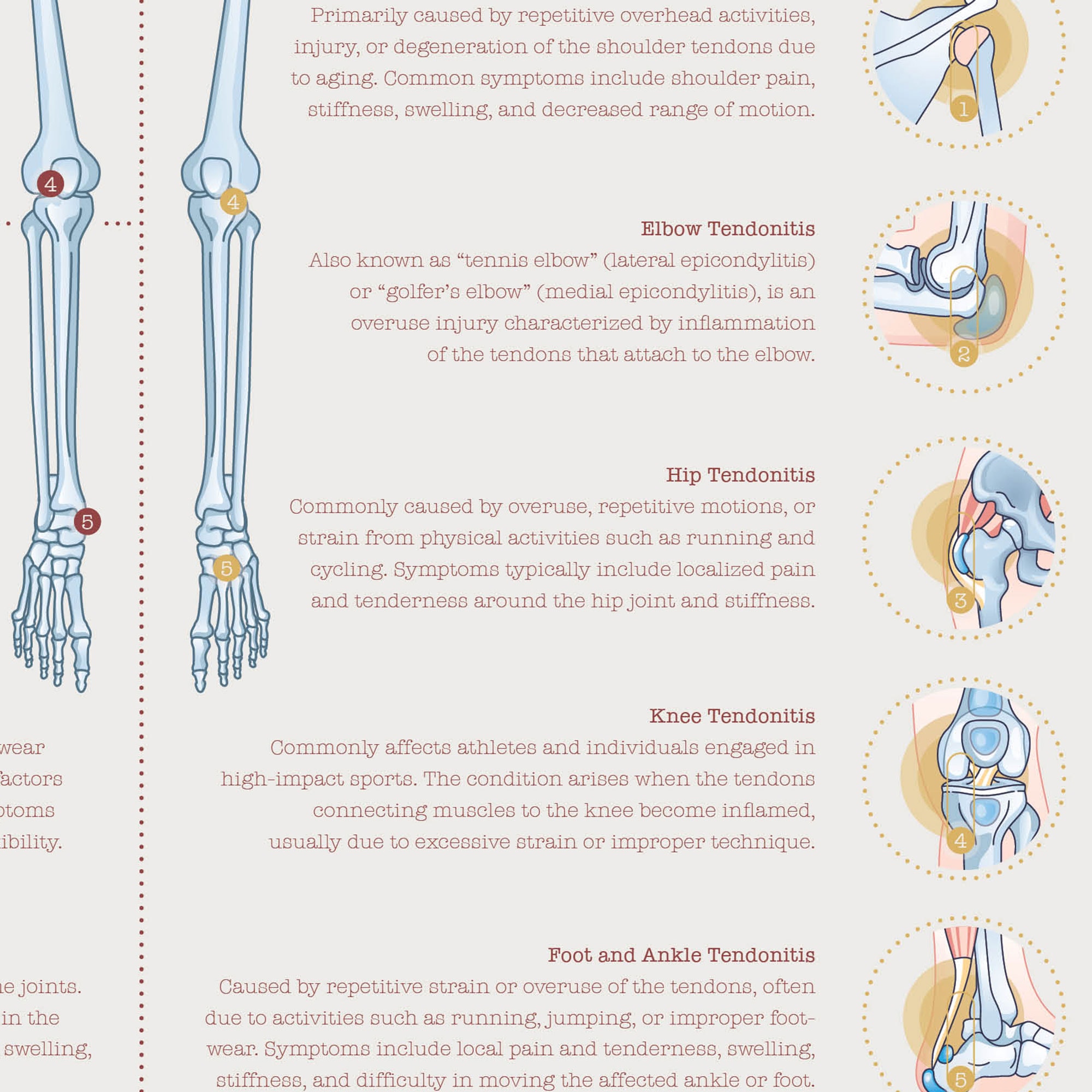 Bursitis Arthritis & Tendonitis