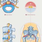 Mechanism of Sciatica – educare.design Sciatica with Stenosis, Hernia & Piriformis Syndrome