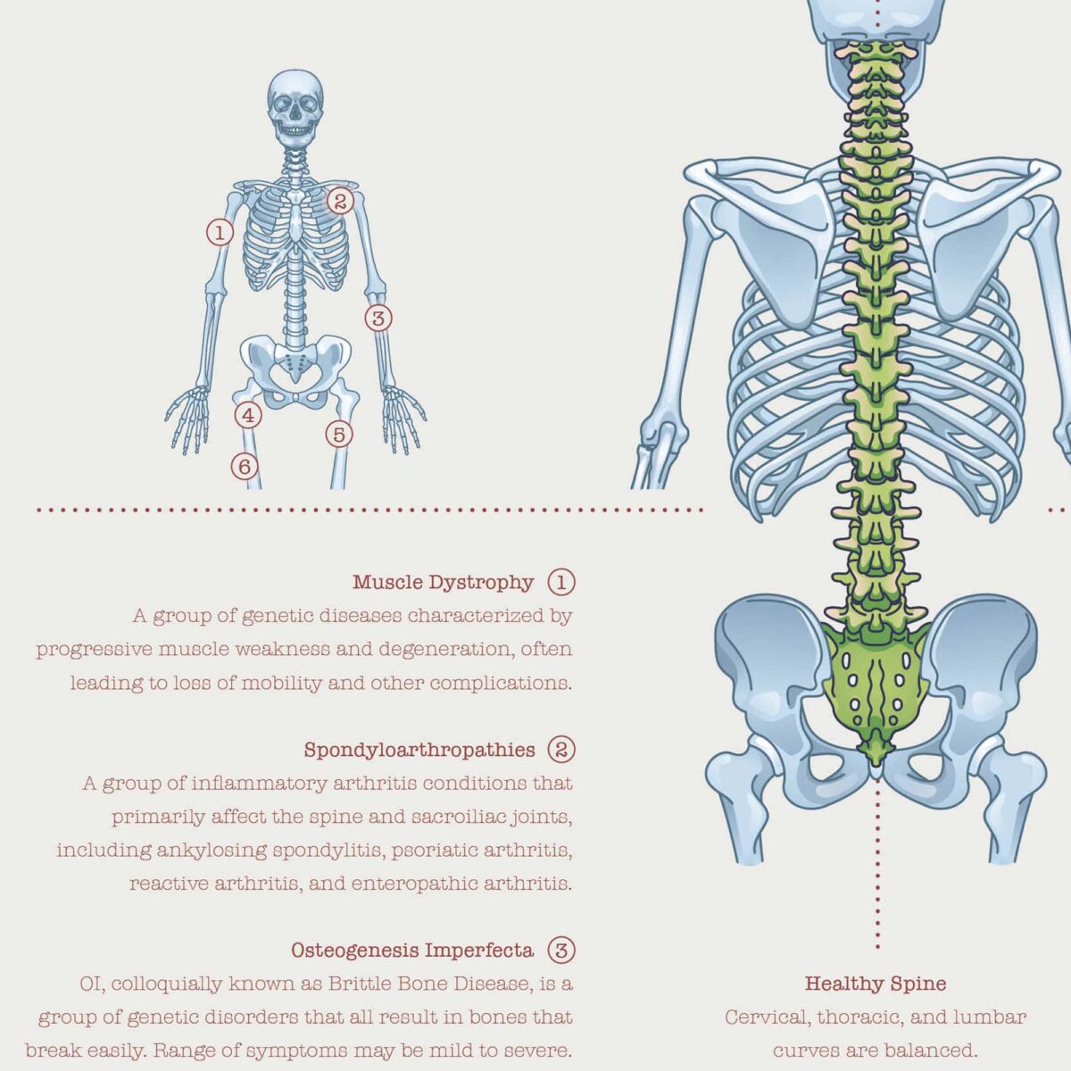 Scoliose et Troubles Musculo-Squelettiques