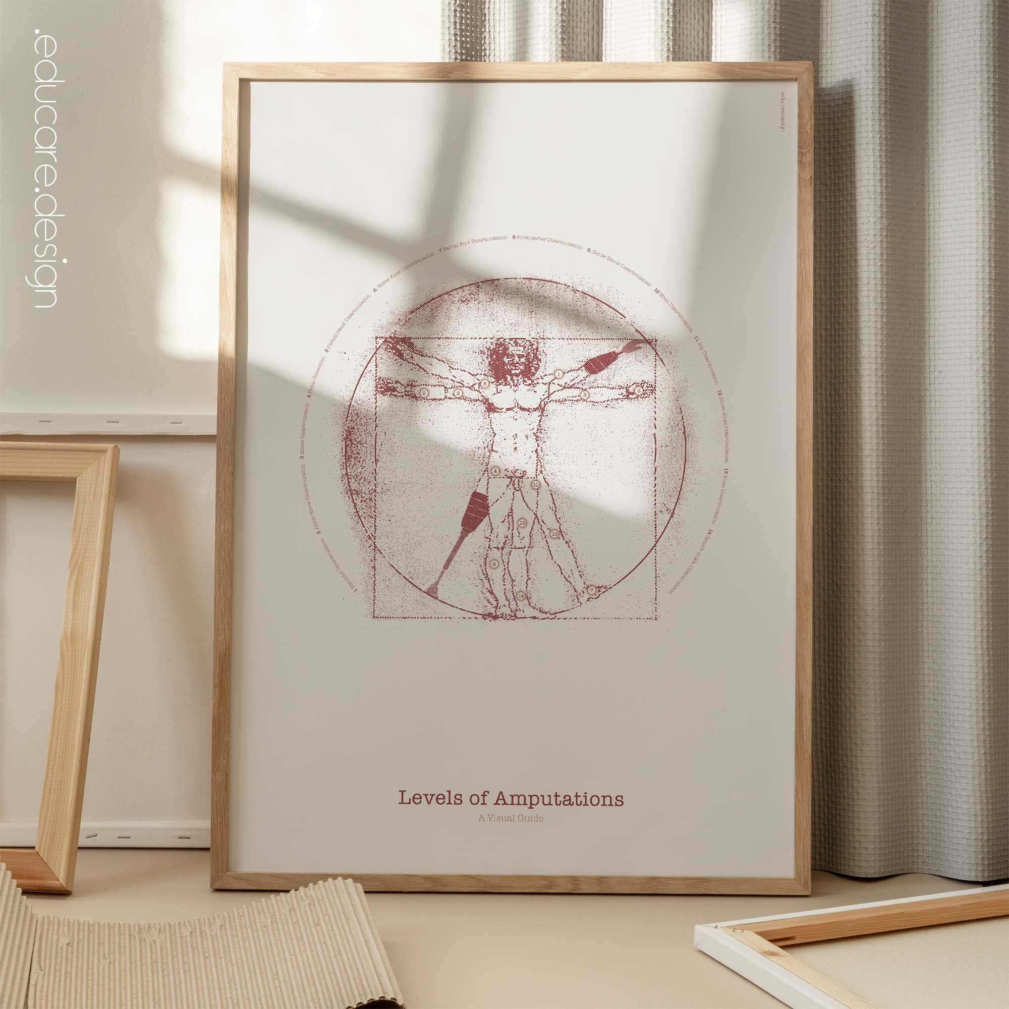 Vetruvian Amputee. Levels of amputations.