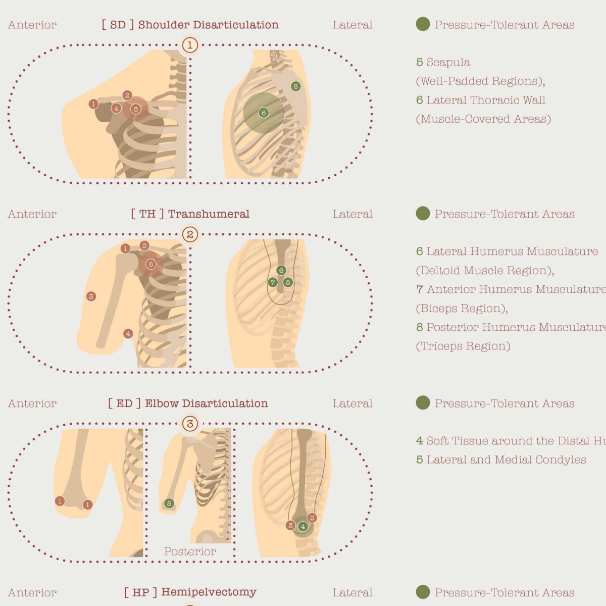 Amputations & Prosthetic Pressure Distribution