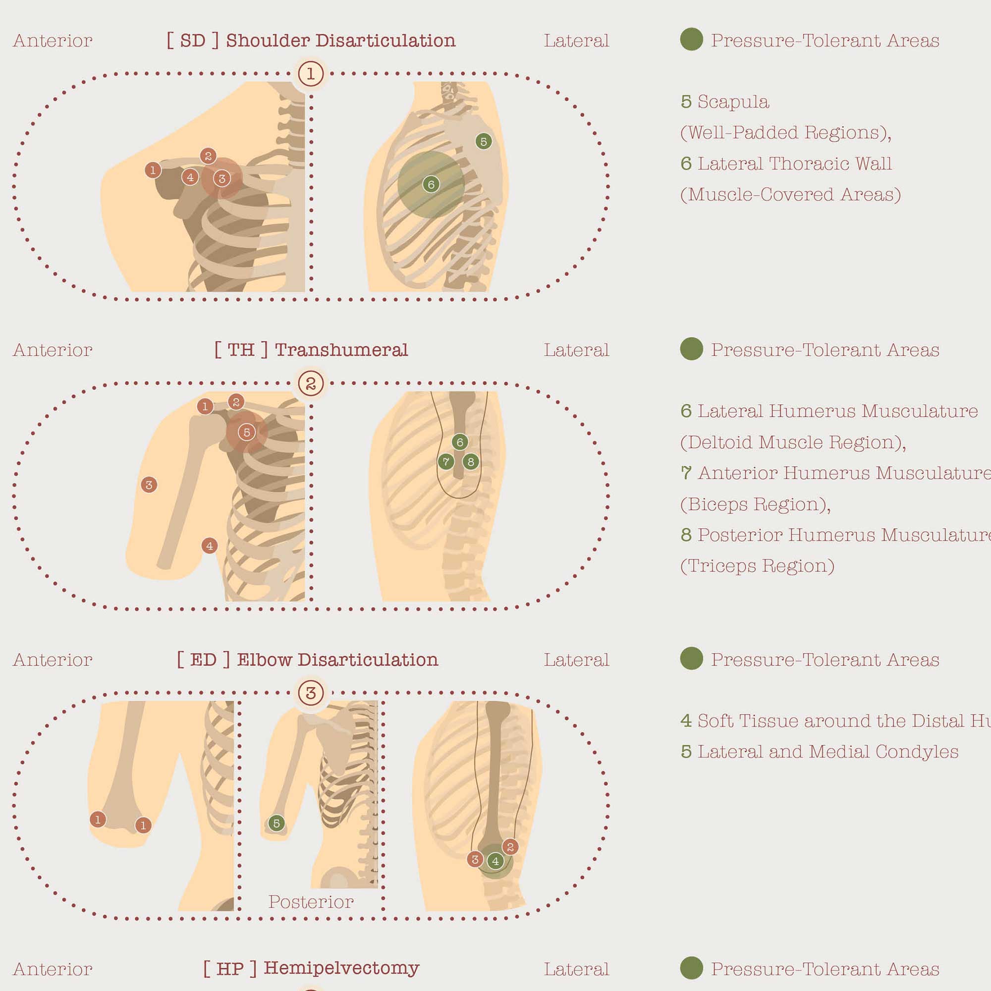 Amputations and Prosthetic Pressure Distribution Set