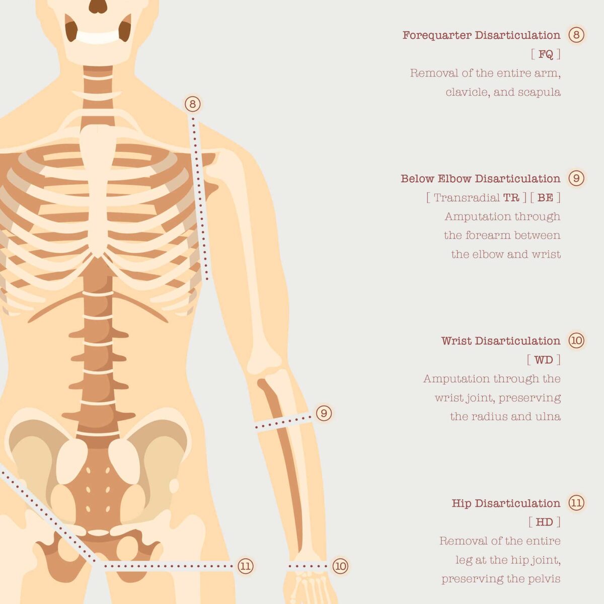 Amputations & Prosthetic Pressure Distribution