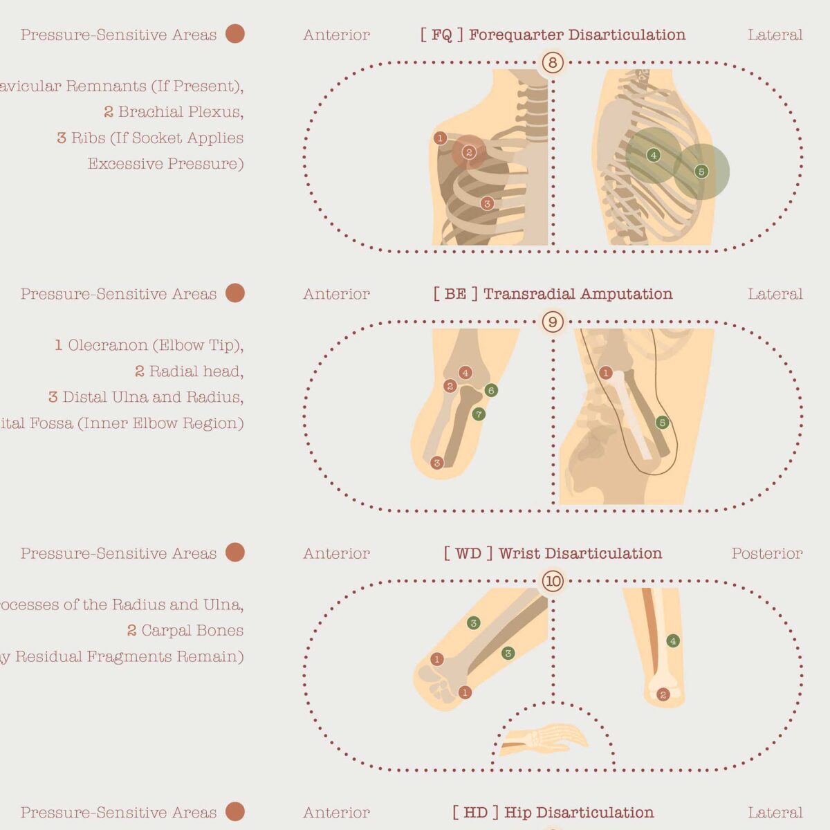 Amputations & Prosthetic Pressure Distribution