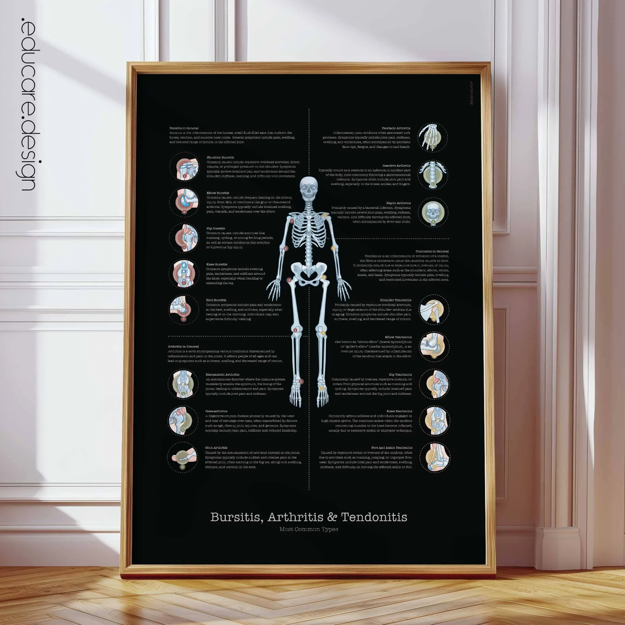 Cuadro anatómico de la bursitis, artritis y tendinitis, edición en negro