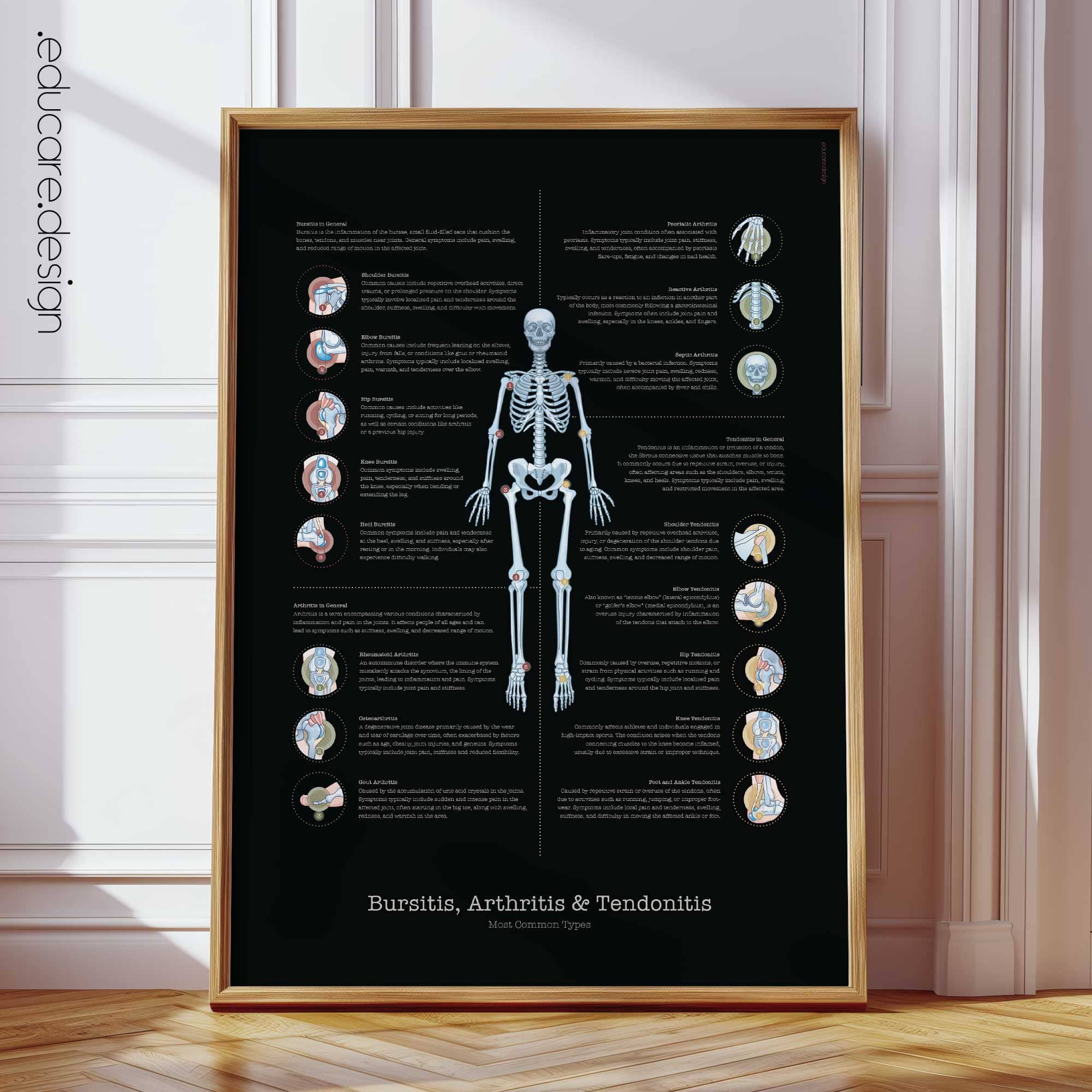 Bursitis Arthritis and Tendonitis Anatomy Chart, Black Edition