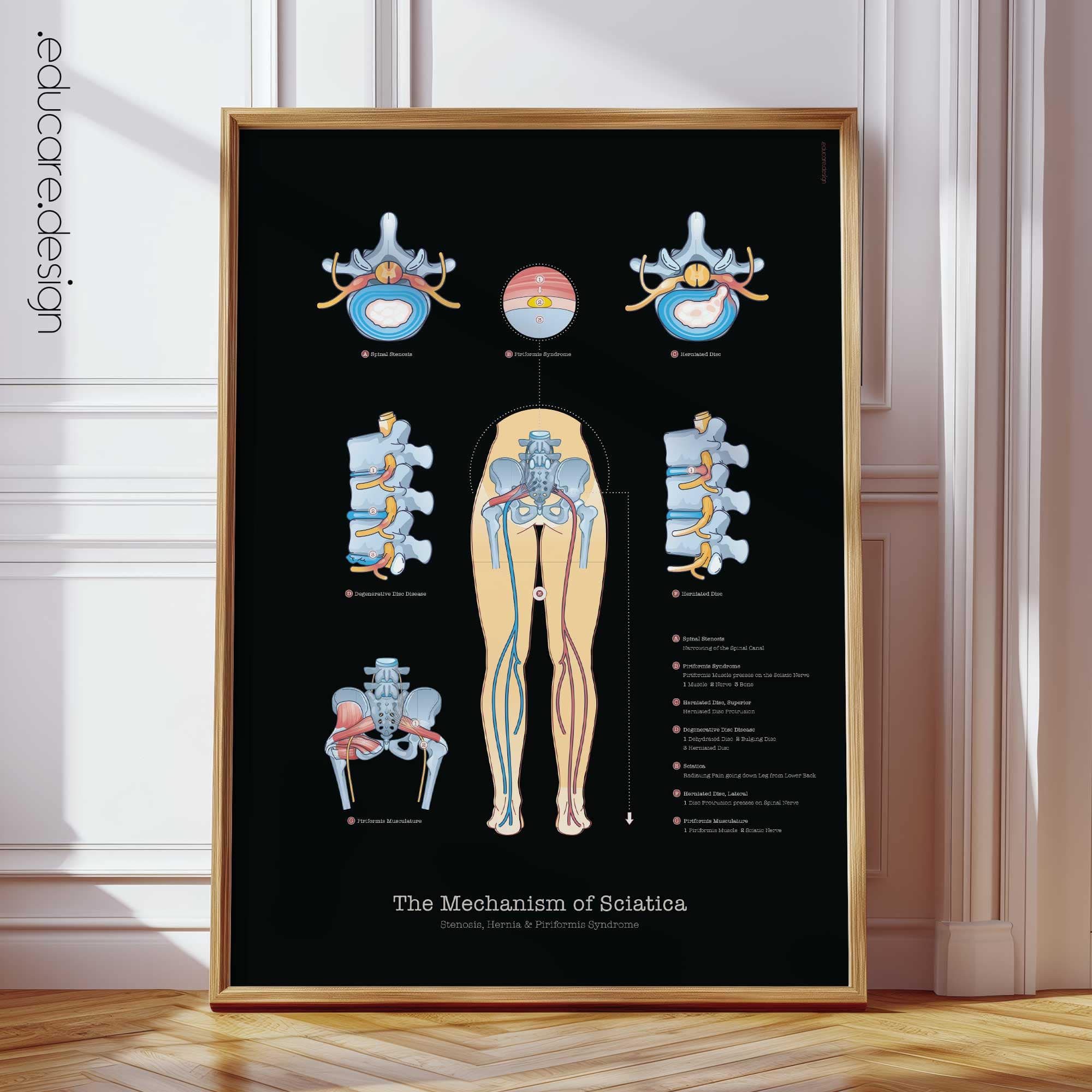 Sciatica Anatomy Chart, Black Edition