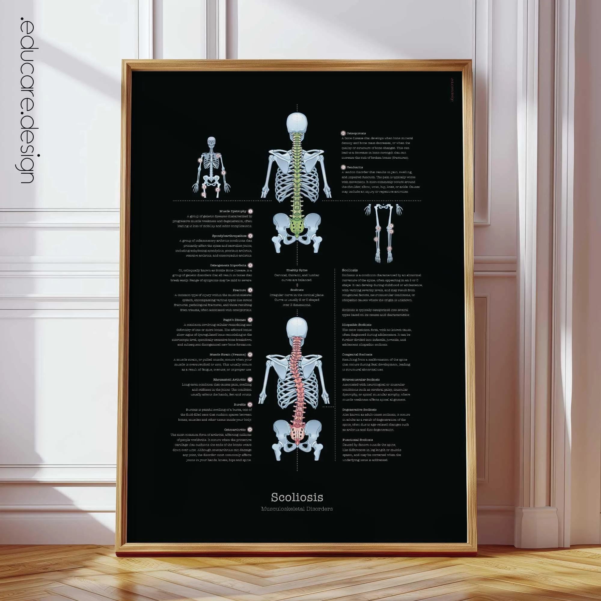 Cuadro anatómico de la escoliosis, edición en negro