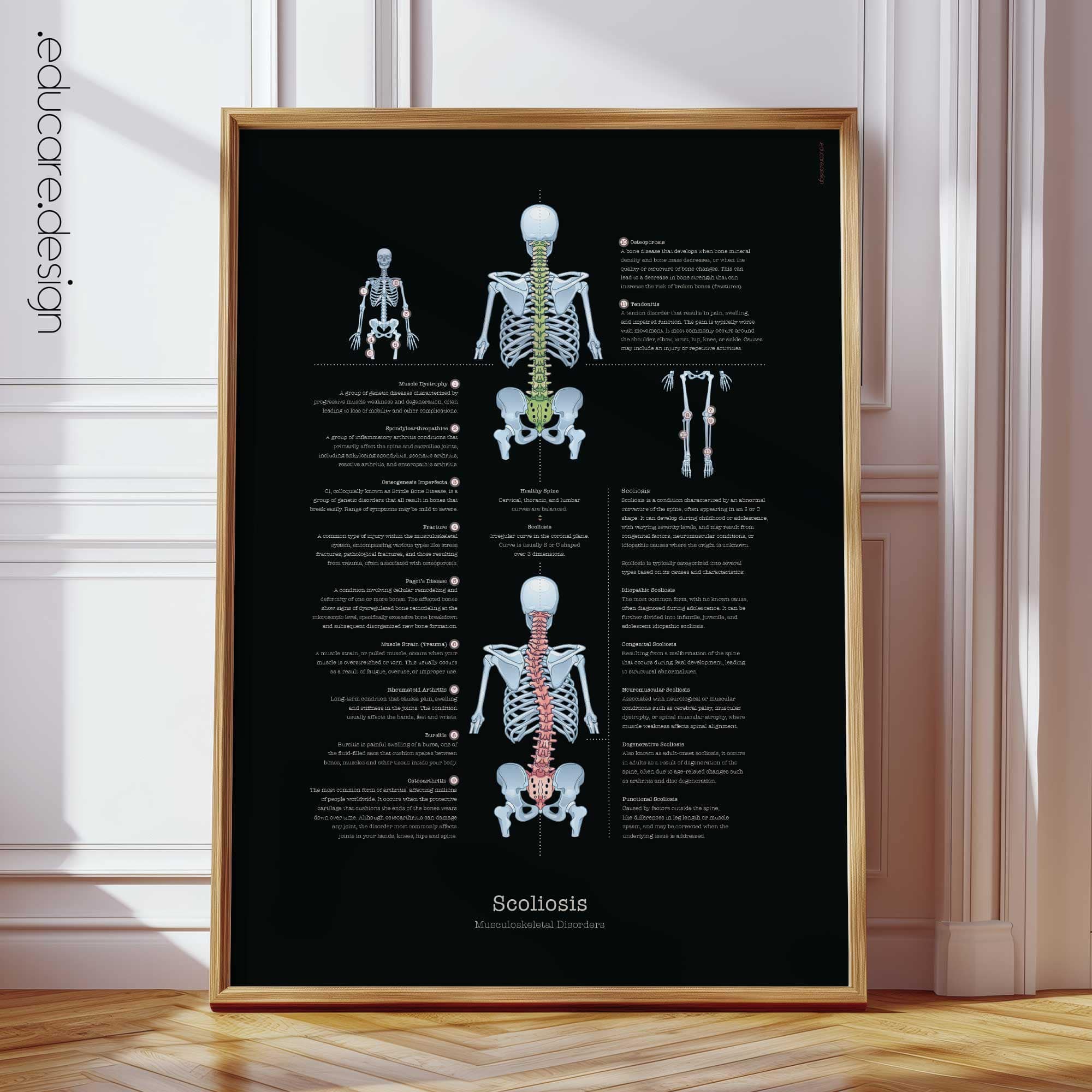 Scoliosis Anatomy Chart, Black Edition