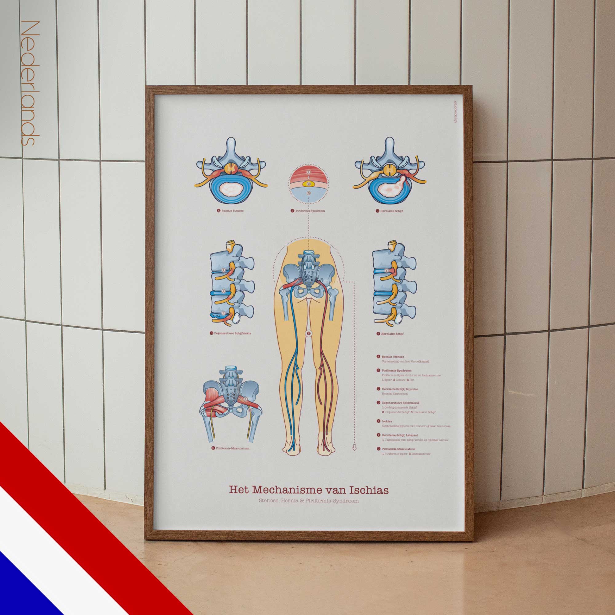 Sciatica with Stenosis, Hernia & Piriformis Syndrome