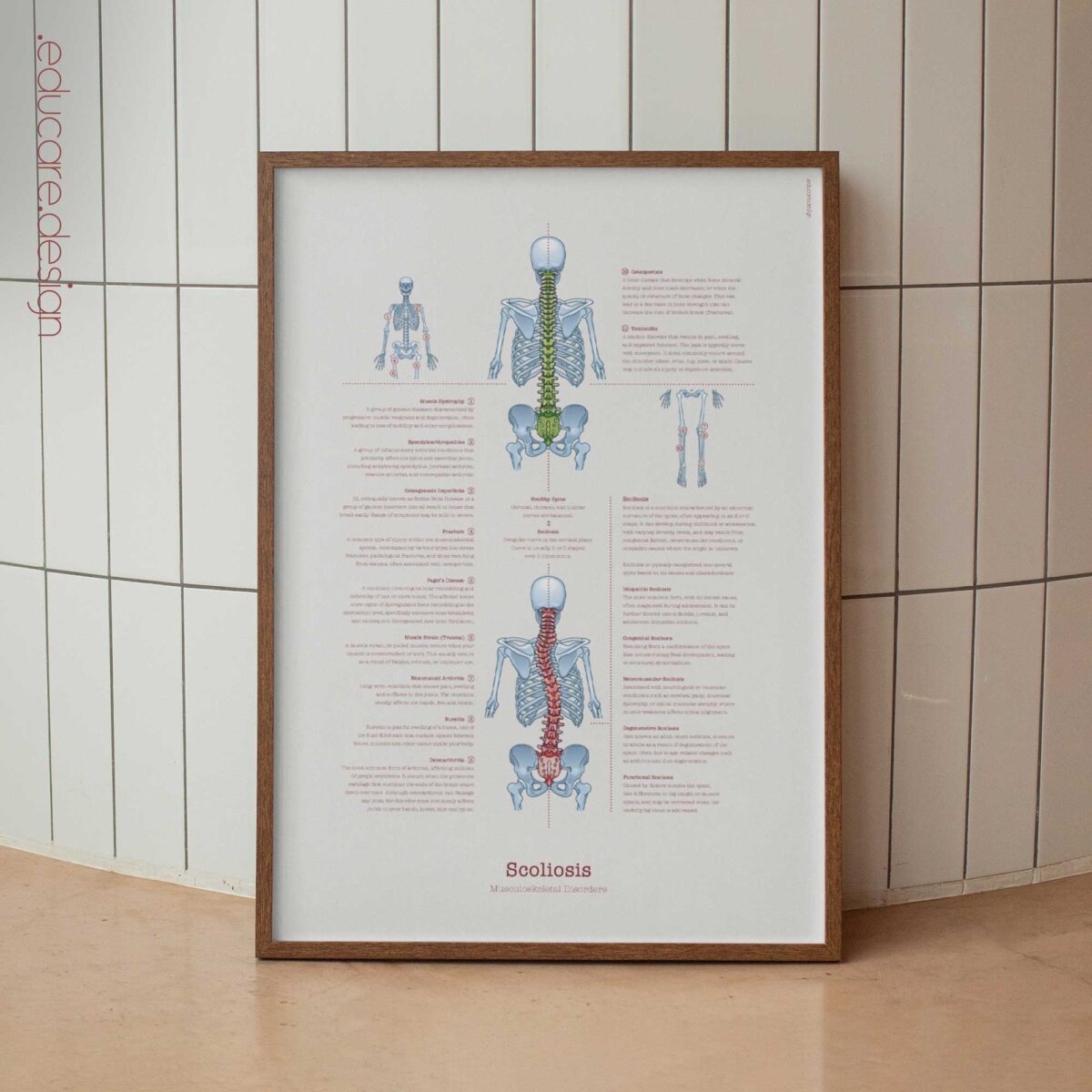 Scoliose et Troubles Musculo-Squelettiques