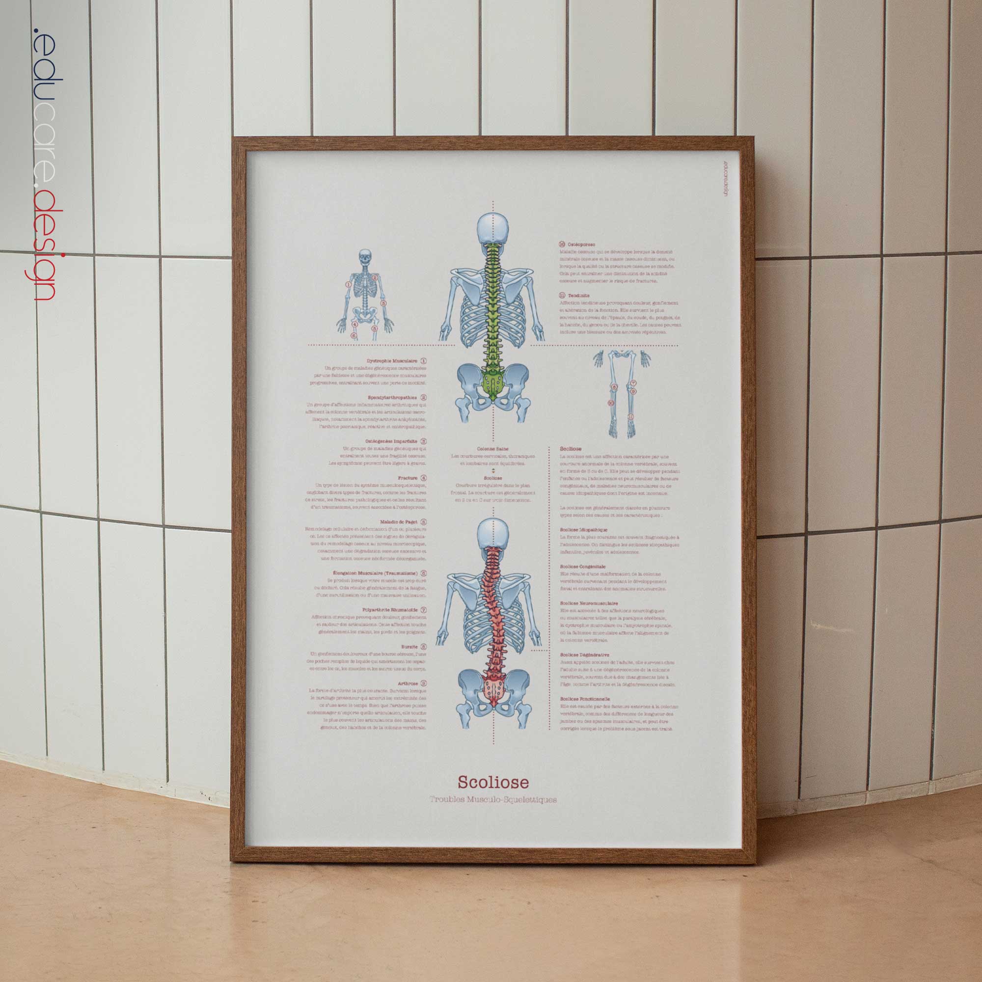 Scoliose et Troubles Musculo-Squelettiques