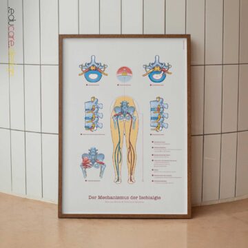 Ischias mit Stenose, Hernie und Piriformis-Syndrom.