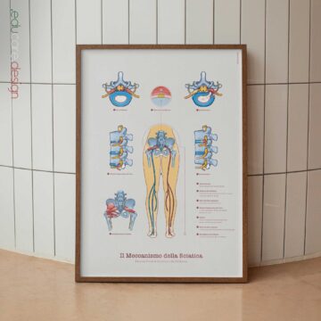 Sciatica con stenosi, ernia e sindrome del piriforme.