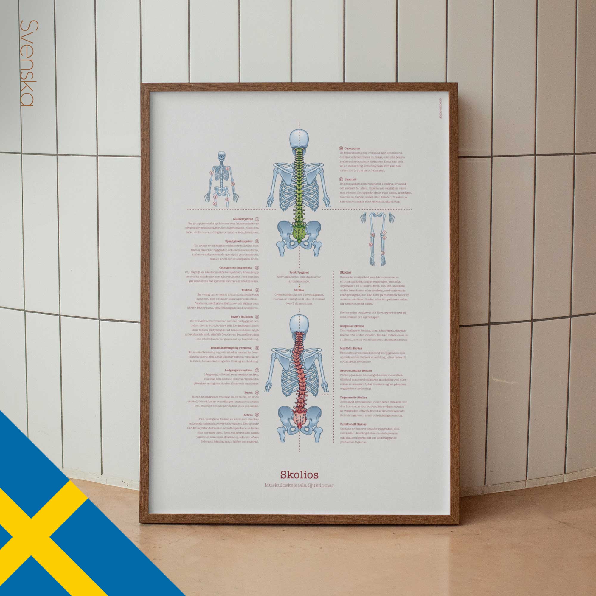 Scoliosis & Musculoskeletal Disorders