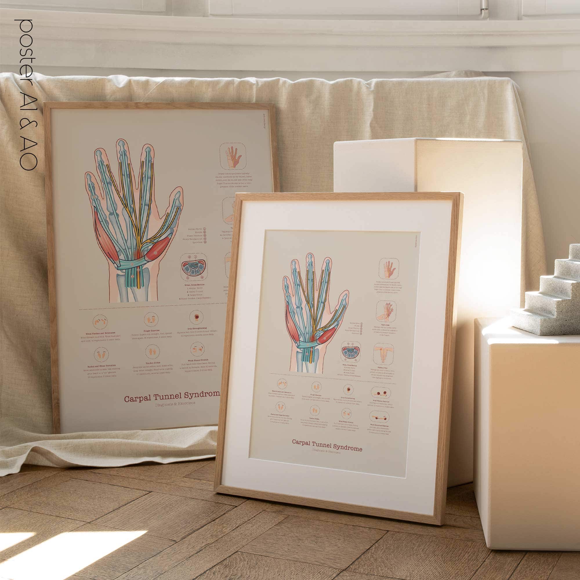 Carpal Tunnel Syndrome with Diagnosis and Exercises