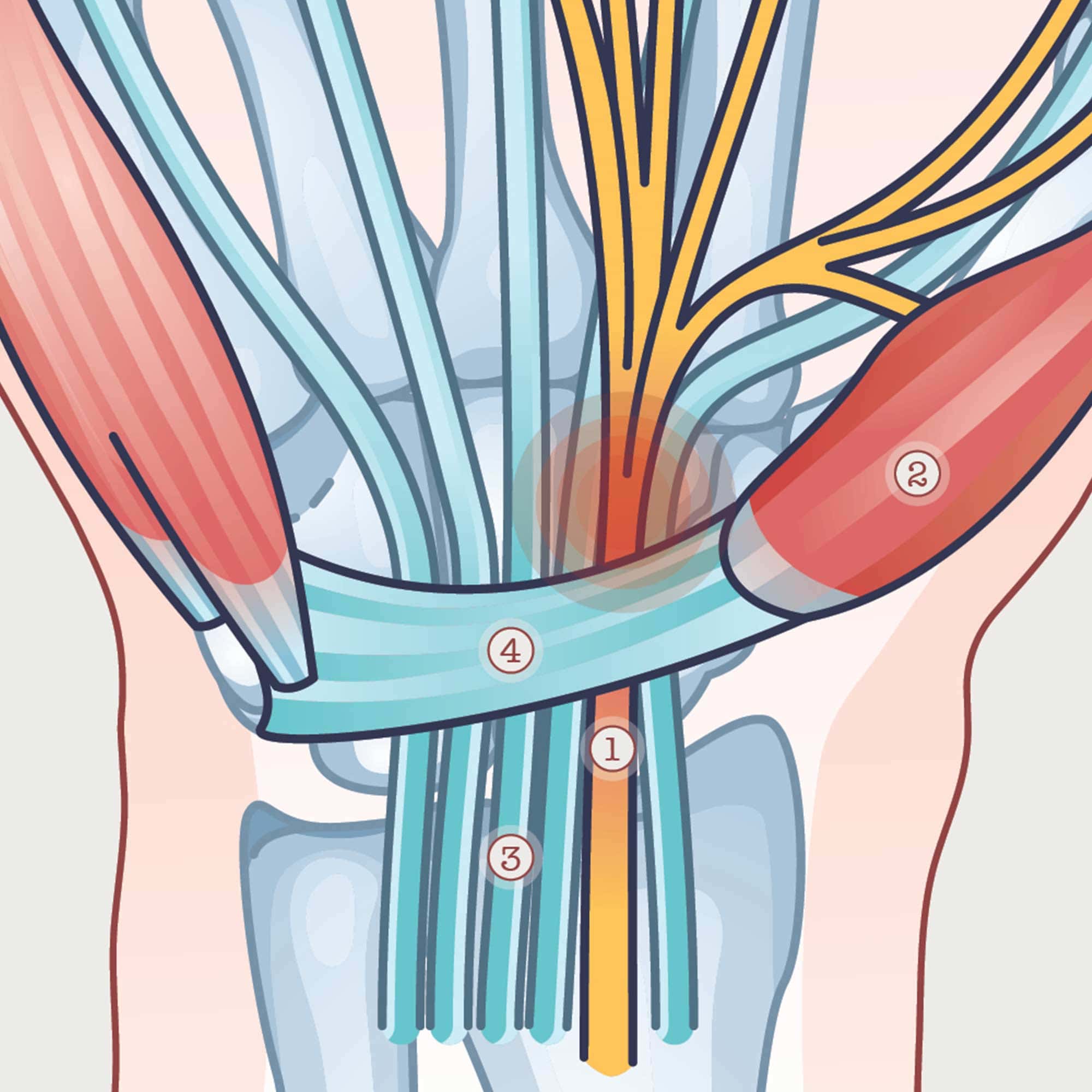 Carpal Tunnel Syndrome with Diagnosis and Exercises
