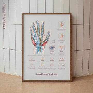 Carpal Tunnel Syndrome with Diagnosis and Exercises