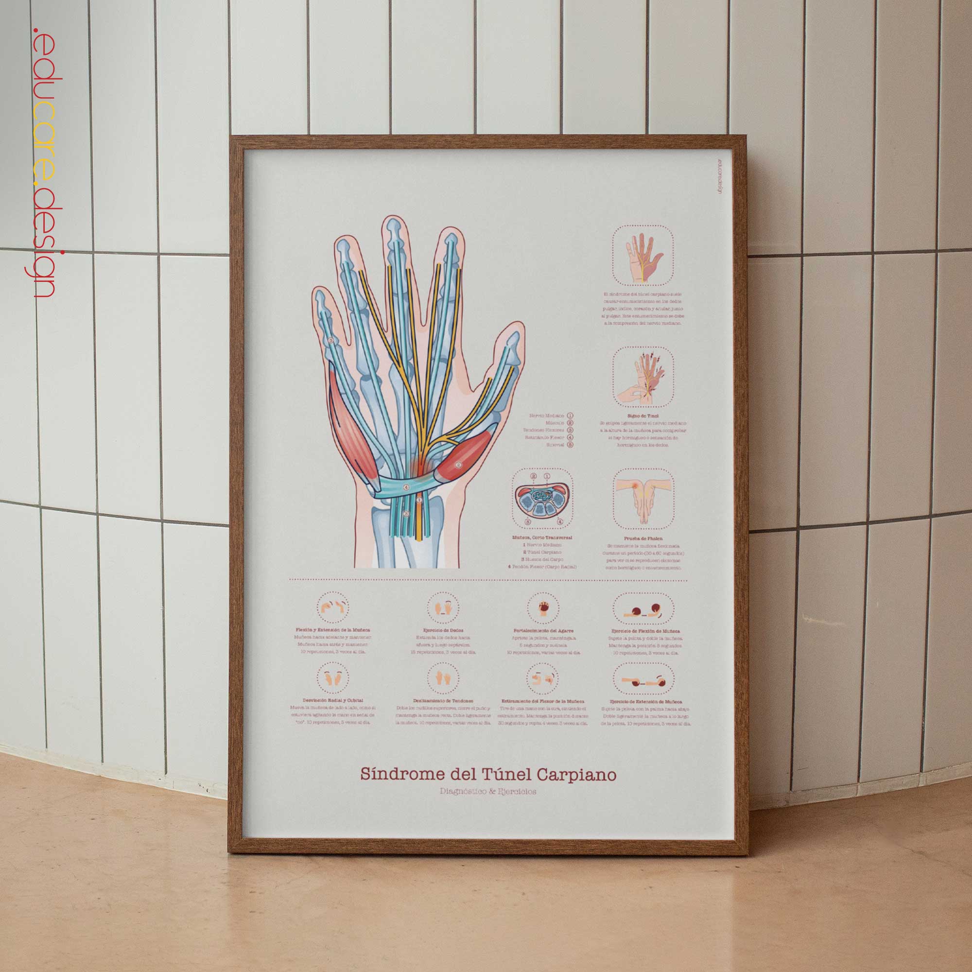 Síndrome del Túnel Carpiano, Diagnóstico y Ejercicios