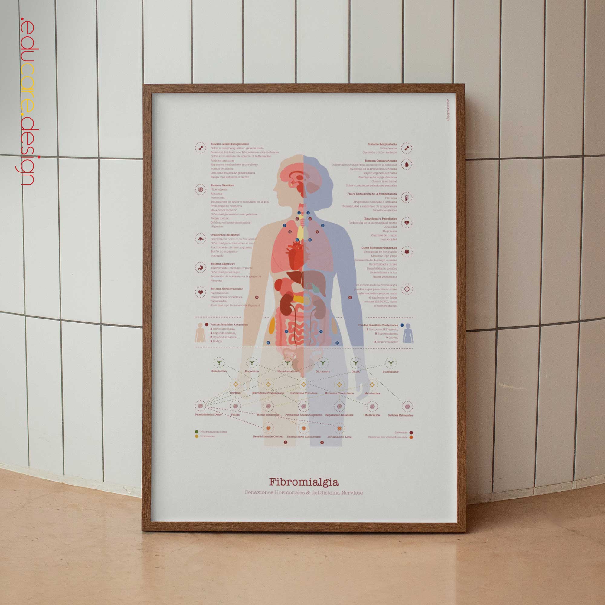 Fibromialgia con Conexiones Hormonales y del Sistema Nervioso lámina anatómica para clínicas y consultas