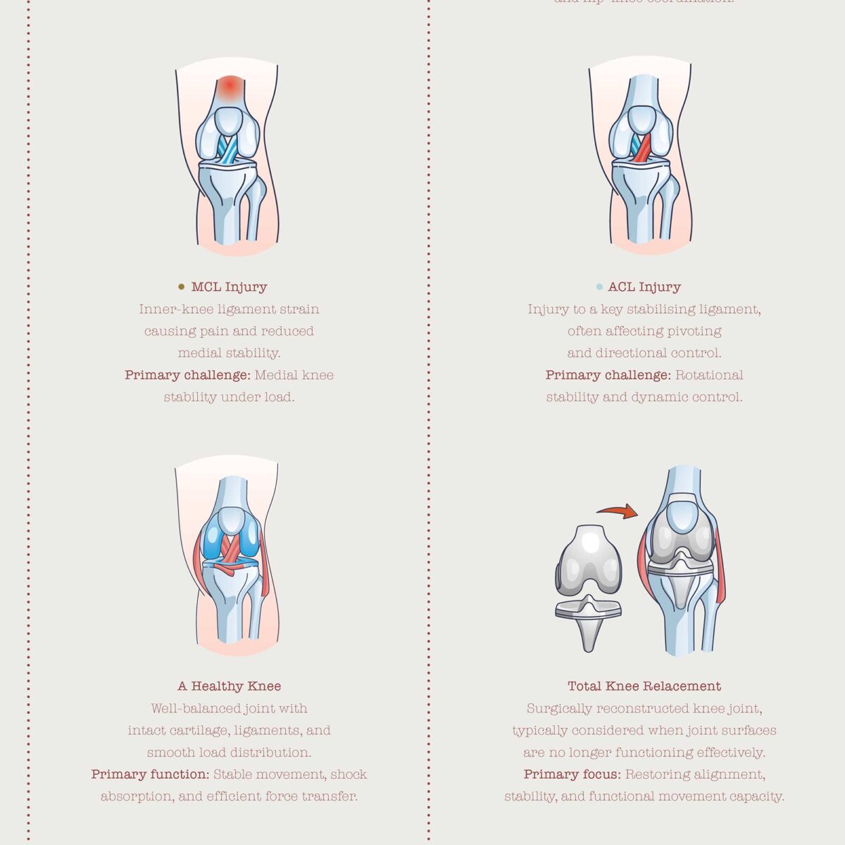 Patient-friendly knee conditions chart illustrating common injuries, degeneration, and altered joint mechanics.