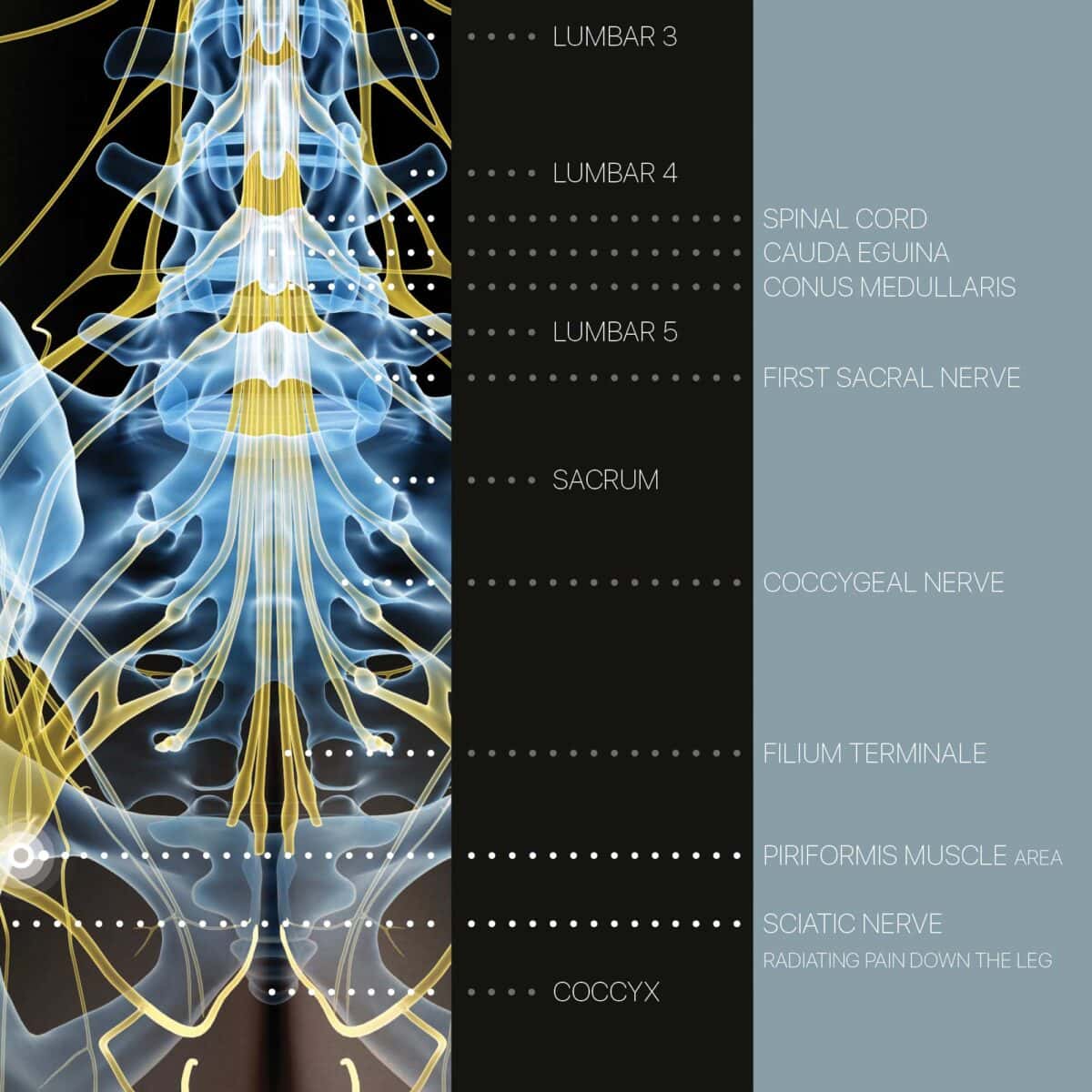 Sciatica e Stenosi