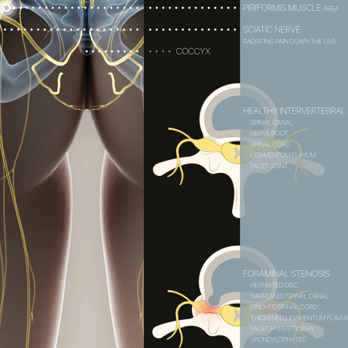 Sciatica e Stenosi