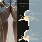Sciatica and Stenosis anatomy chart for clinics